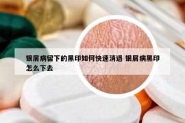 银屑病留下的黑印如何快速消退 银屑病黑印怎么下去