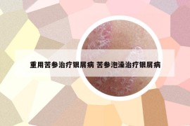 重用苦参治疗银屑病 苦参泡澡治疗银屑病