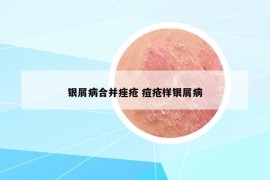 银屑病合并痤疮 痘疮样银屑病