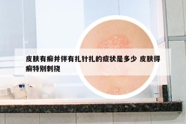 皮肤有癣并伴有扎针扎的症状是多少 皮肤得癣特别刺挠