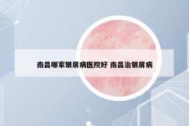 南昌哪家银屑病医院好 南昌治银屑病