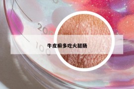 牛皮癣多吃火腿肠