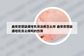 曲安奈德益康唑乳膏治癣怎么样 曲安奈德益康唑乳膏止痒吗的作用