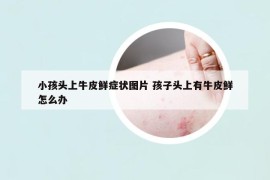 小孩头上牛皮鲜症状图片 孩子头上有牛皮鲜怎么办