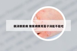 藕汤银屑病 银屑病银耳莲子汤能不能吃