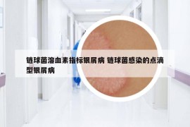 链球菌溶血素指标银屑病 链球菌感染的点滴型银屑病