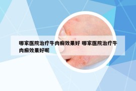 哪家医院治疗牛肉癣效果好 哪家医院治疗牛肉癣效果好呢