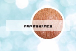 白癜风最容易长的位置
