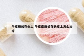 牛皮癣长在头上 牛皮皮癣长在头皮上怎么治疗