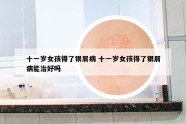 十一岁女孩得了银屑病 十一岁女孩得了银屑病能治好吗
