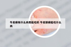 牛皮癣有什么肉类能吃的 牛皮肤癣能吃什么肉