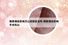 银屑病会影响刀口皮肤愈合吗 银屑病会影响手术伤口
