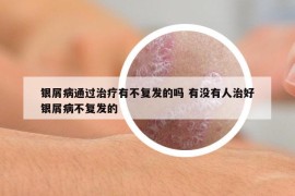 银屑病通过治疗有不复发的吗 有没有人治好银屑病不复发的