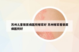 苏州儿童银屑病医院哪家好 苏州哪家看银屑病医院好