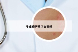 牛皮癣严重了会死吗
