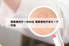 银屑病光疗一次80元 银屑病光疗多久一个疗程