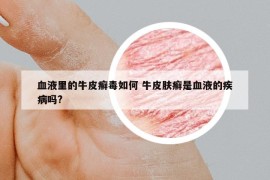 血液里的牛皮癣毒如何 牛皮肤癣是血液的疾病吗?
