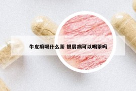 牛皮癣喝什么茶 银屑病可以喝茶吗