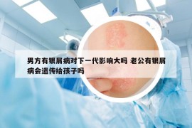 男方有银屑病对下一代影响大吗 老公有银屑病会遗传给孩子吗