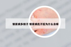 银屑病多排汗 银屑病出汗后为什么会痒