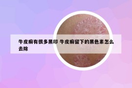牛皮癣有很多黑印 牛皮癣留下的黑色素怎么去除