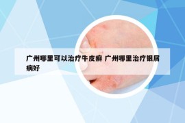 广州哪里可以治疗牛皮癣 广州哪里治疗银屑病好