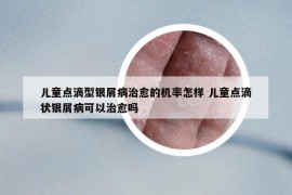 儿童点滴型银屑病治愈的机率怎样 儿童点滴状银屑病可以治愈吗