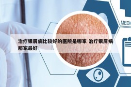 治疗银屑病比较好的医院是哪家 治疗银屑病那家最好