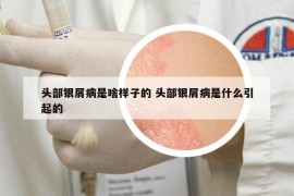 头部银屑病是啥样子的 头部银屑病是什么引起的