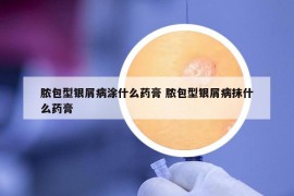 脓包型银屑病涂什么药膏 脓包型银屑病抹什么药膏
