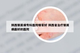 陕西银屑病专科医院哪家好 陕西省治疗银屑病最好的医院