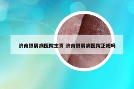 济南银屑病医院主页 济南银屑病医院正规吗