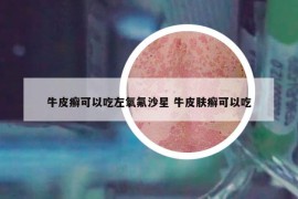 牛皮癣可以吃左氧氟沙星 牛皮肤癣可以吃