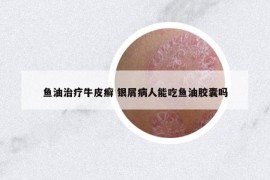 鱼油治疗牛皮癣 银屑病人能吃鱼油胶囊吗
