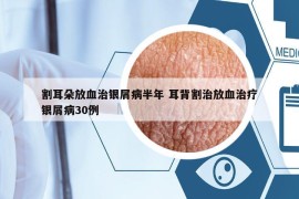 割耳朵放血治银屑病半年 耳背割治放血治疗银屑病30例