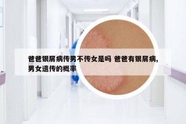爸爸银屑病传男不传女是吗 爸爸有银屑病,男女遗传的概率