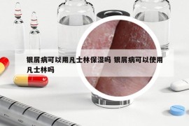 银屑病可以用凡士林保湿吗 银屑病可以使用凡士林吗