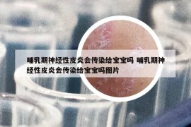 哺乳期神经性皮炎会传染给宝宝吗 哺乳期神经性皮炎会传染给宝宝吗图片