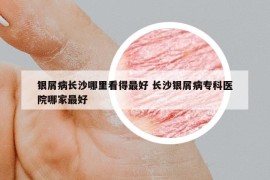 银屑病长沙哪里看得最好 长沙银屑病专科医院哪家最好