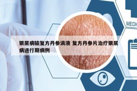 银屑病输复方丹参滴液 复方丹参片治疗银屑病进行期病例