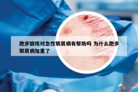 跑步锻炼对急性银屑病有帮助吗 为什么跑步银屑病加重了