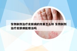 生物制剂治疗皮肤病的效果怎么样 生物制剂治疗皮肤病能根治吗