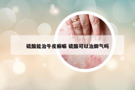 硫酸能治牛皮癣嘛 硫酸可以治脚气吗