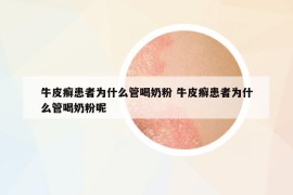 牛皮癣患者为什么管喝奶粉 牛皮癣患者为什么管喝奶粉呢