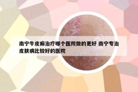 南宁牛皮癣治疗哪个医院做的更好 南宁专治皮肤病比较好的医院