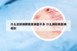 什么皮肤病跟银屑病差不多 什么病和银屑病相似