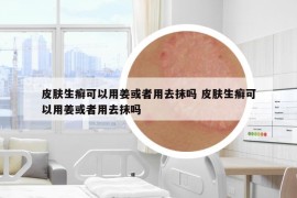 皮肤生癣可以用姜或者用去抹吗 皮肤生癣可以用姜或者用去抹吗