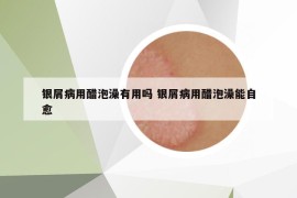银屑病用醋泡澡有用吗 银屑病用醋泡澡能自愈