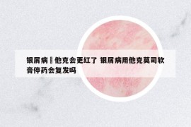 银屑病凃他克会更红了 银屑病用他克莫司软膏停药会复发吗