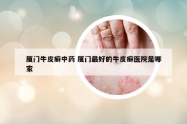 厦门牛皮癣中药 厦门最好的牛皮癣医院是哪家